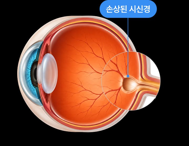 눈 단면도 — 시신경 부위